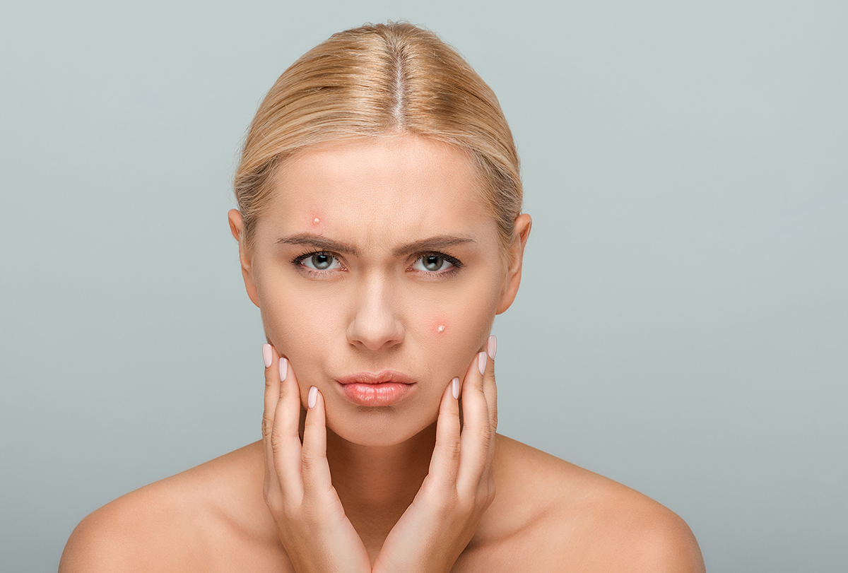 can high estrogen levels cause acne?