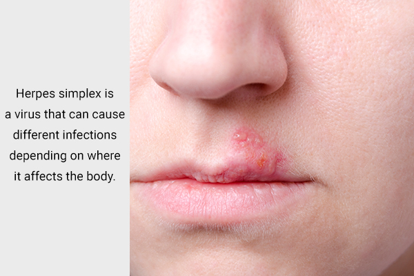 the herpes simplex virus can lead to infections and pimples on the throat