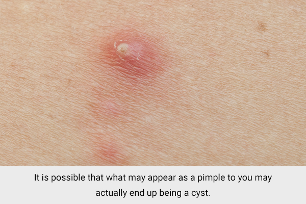 how to differentiate pimple on the knee from a cyst?