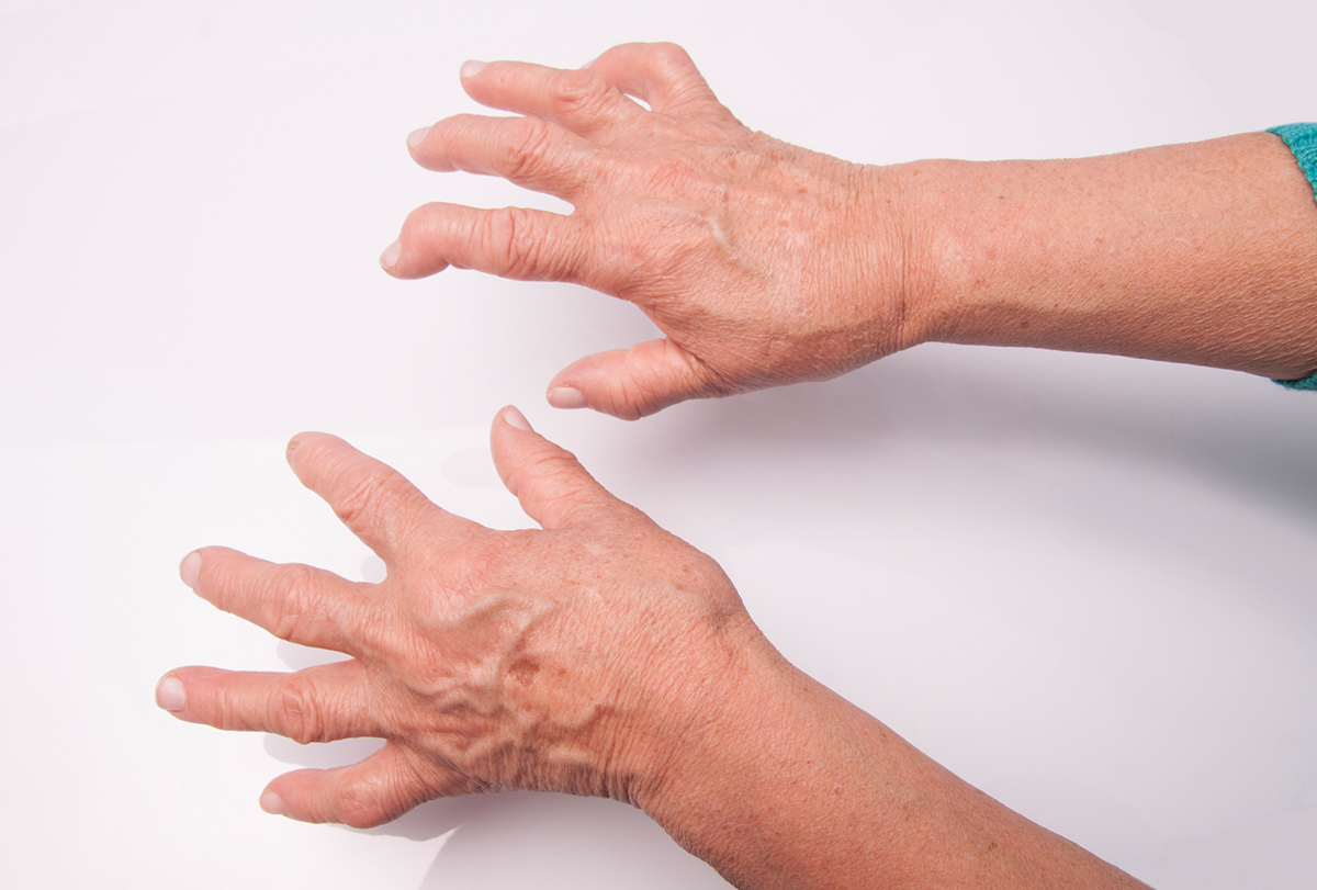 osteoarthritis hands