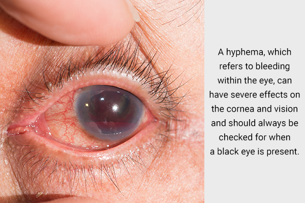 is black eye a serious medical concern?