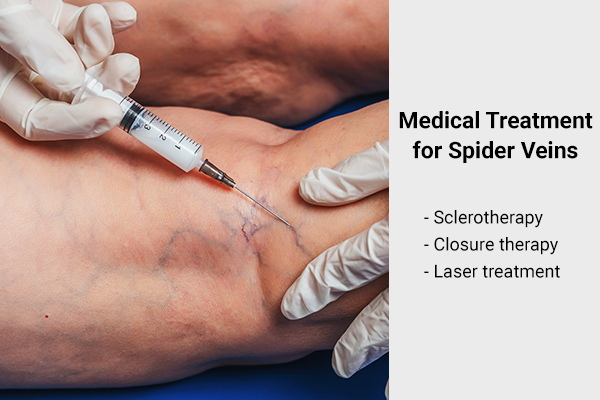 medical interventions to treat spider veins