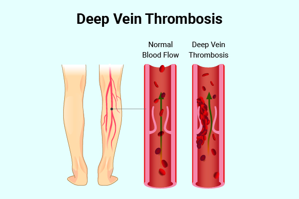 signs and symptoms indicative of deep vein thrombosis
