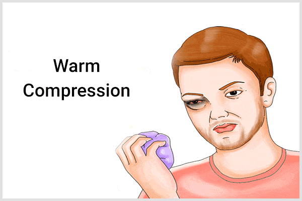 how to use a warm compress to soothe a black eye