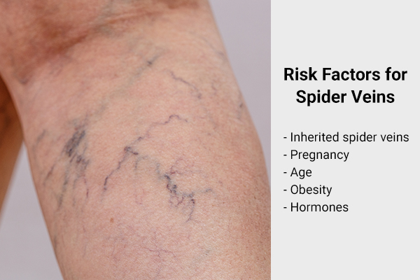 risk factors for spider veins