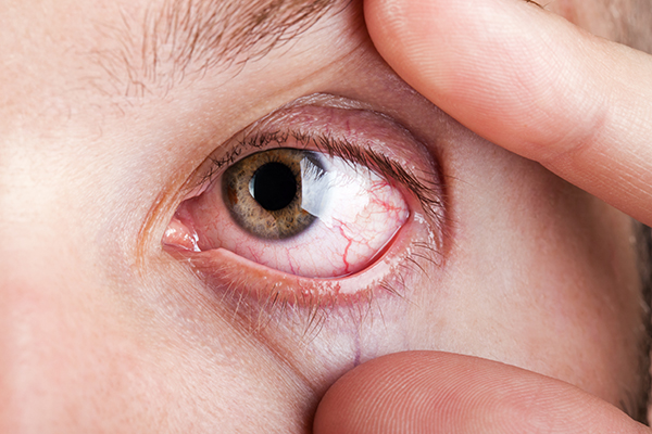 types of dry eyes disorders