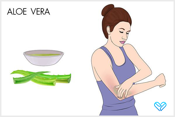 use fresh aloe vera gel to manage postpartum hives