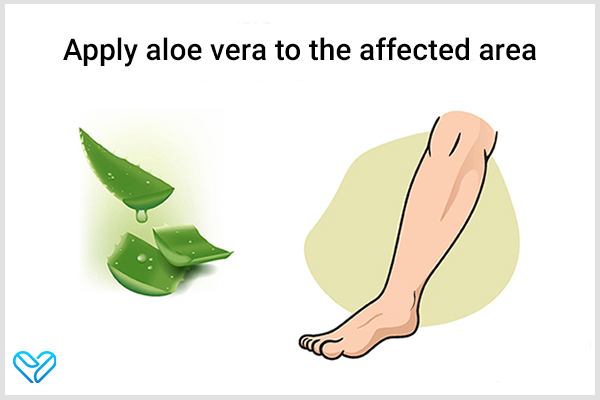 try applying aloe vera to your heels and manage heel spurs