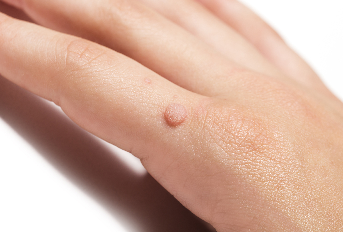 flat warts: causes, signs, and treatment