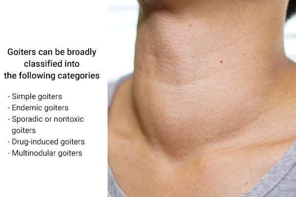 types and classifications of goiter