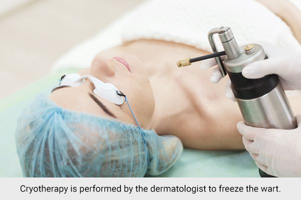 cryotherapy therapy for treating flat warts