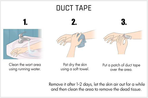 applying a duct tape over the wart to facilitate healing