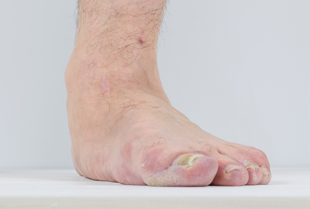 heel spurs: causes, signs, and treatment