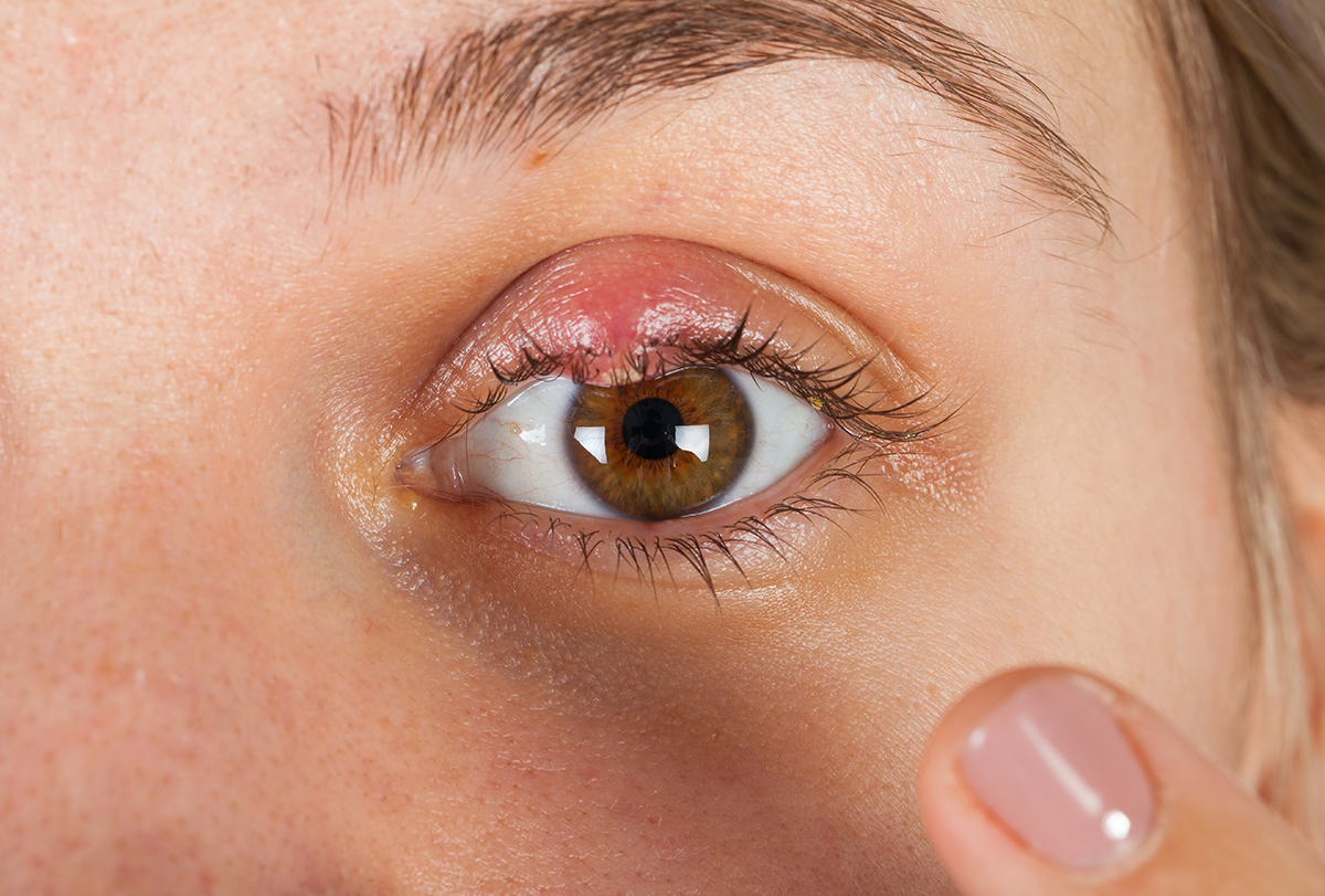 8-home-remedies-to-get-rid-of-eye-stye-emedihealth