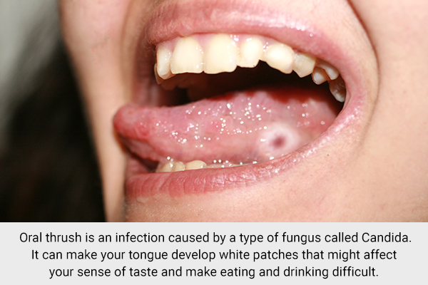 an outbreak of oral thrush can lead to sore tongue