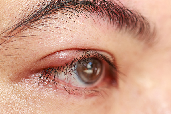 preventive tips to reduce the risk of eye stye formation