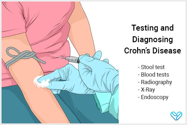 testing for and diagnosing crohn's disease