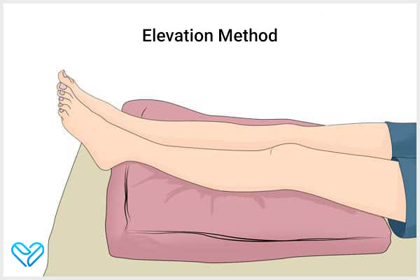 elevating the affected area can help deal with chondromalacia patellae