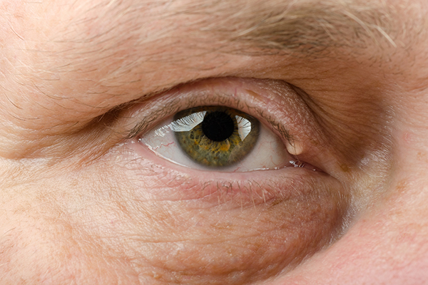 the characteristic symptoms of eyelid cysts