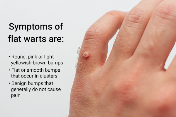 common signs and symptoms of flat warts