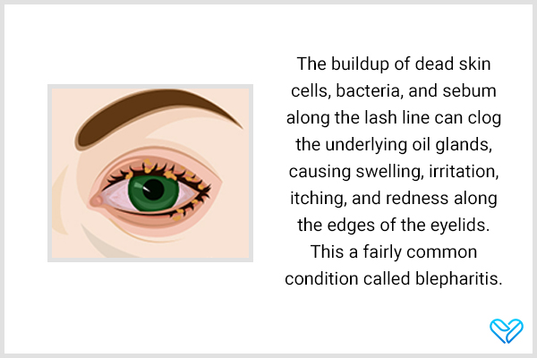 blepharitis can often be mistaken for pink eye as both have similar signs