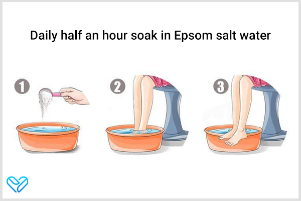 soak your heels in Epsom salt water to manage heel spurs