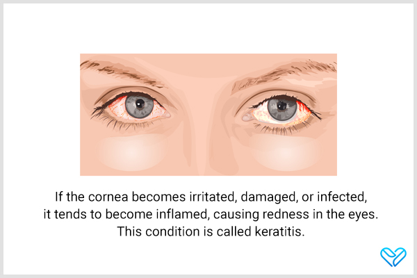 keratitis can be misdiagnosed as pink eye since both share similar symptoms