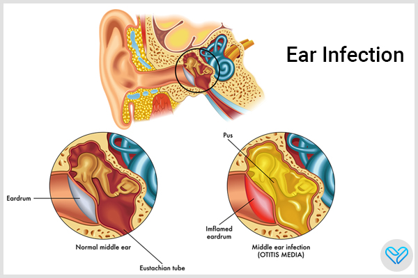 symptoms indicative of ear infections