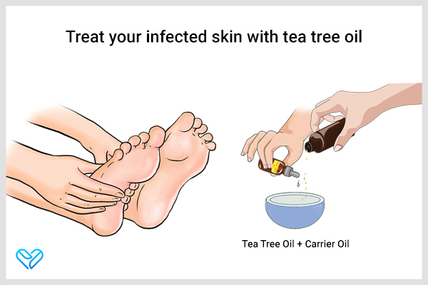 application of tea tree oil can help relieve athlete's foot