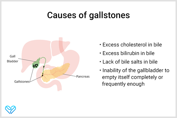 what causes gallstones?