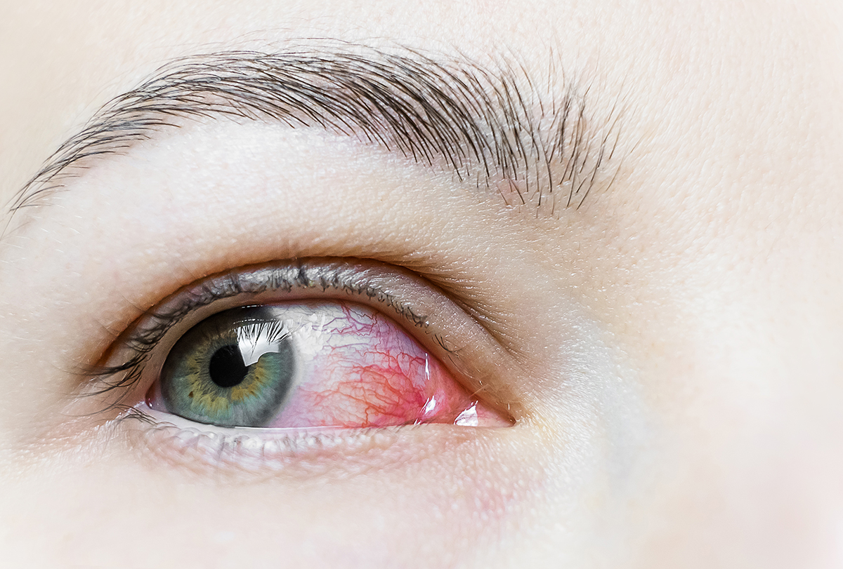 7 Conditions Commonly Misdiagnosed As Pink Eye - eMediHealth