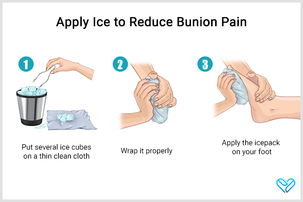 ice application to the affected area can help reduce bunion pain