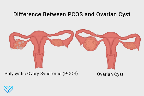 differences between PCOS and ovarian cysts