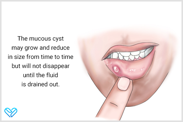 how can you tell if your oral cyst is a mucocele?