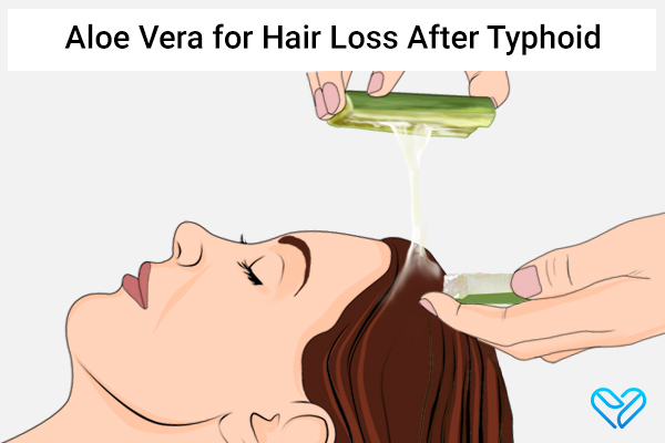 aloe vera to manage hair loss post-typhoid