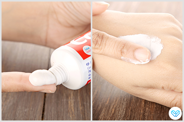 is it safe to use toothpaste on bruises?