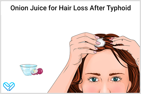 onion juice to manage hair loss after typhoid