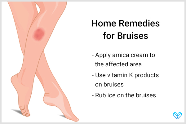 home remedies that can help heal bruises