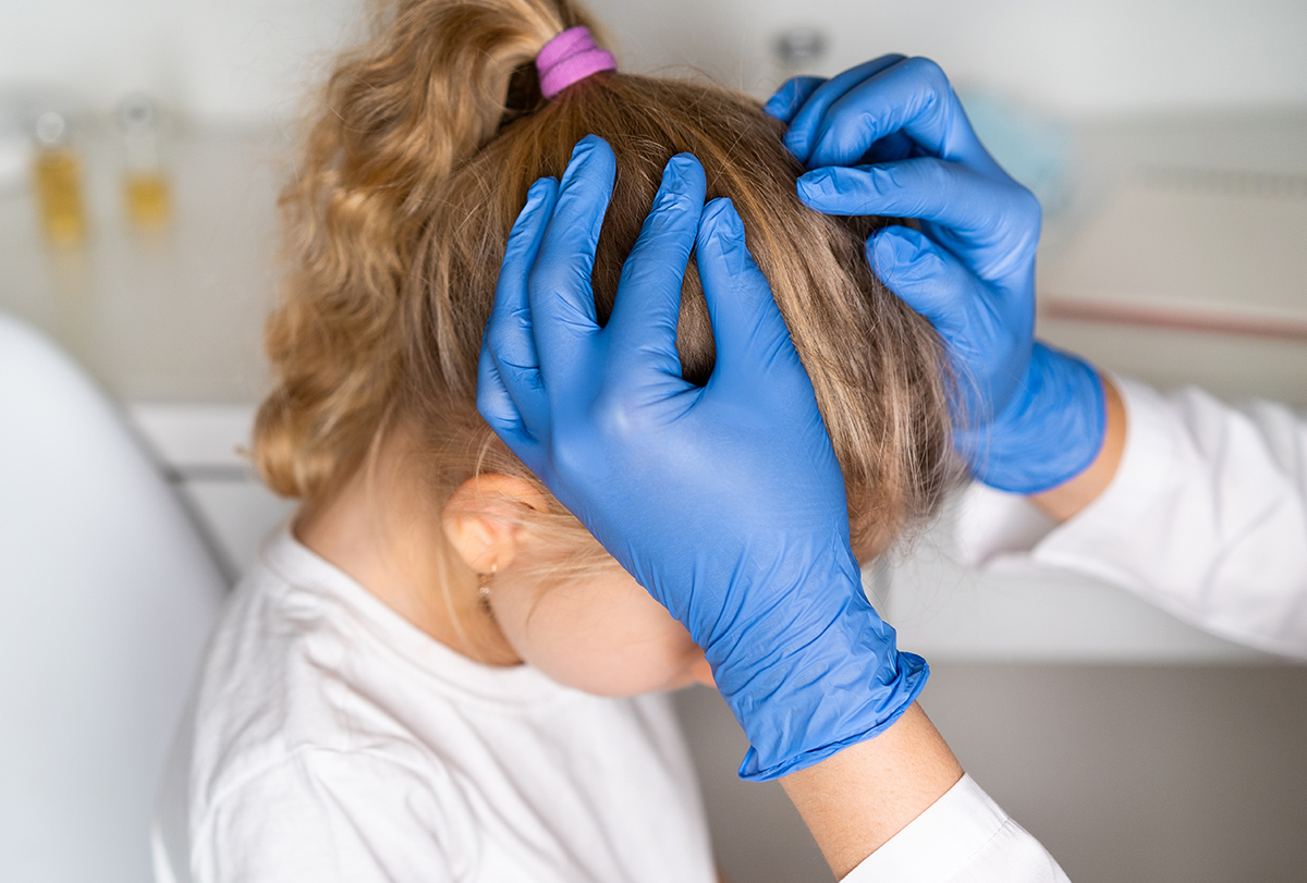 can lice cause hair loss
