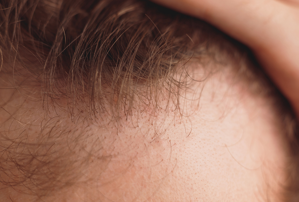 is scalp micropigmentation permanent